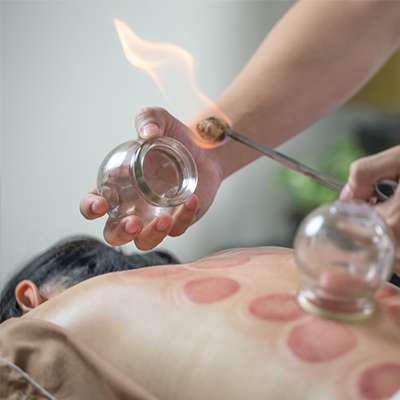 Moxibustion-cupping-1